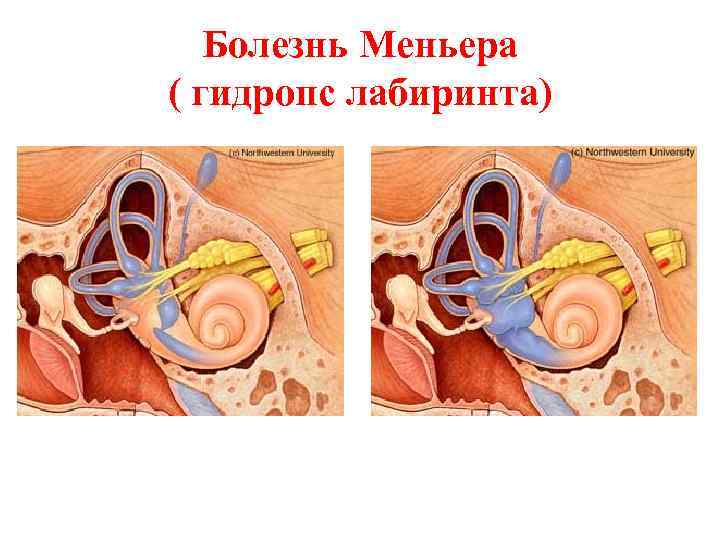 Болезнь Меньера ( гидропс лабиринта) 