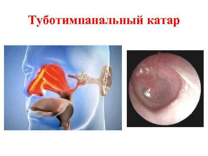 Туботимпанальный катар 