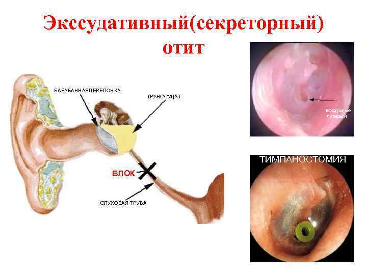 Экссудативный(секреторный) отит БАРАБАННАЯПЕРЕПОНКА ТРАНССУДАТ Воздушные пузырьки ТИМПАНОСТОМИЯ БЛОК СЛУХОВАЯ ТРУБА 