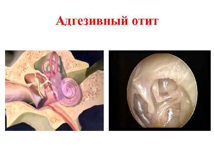Адгезивный отит 