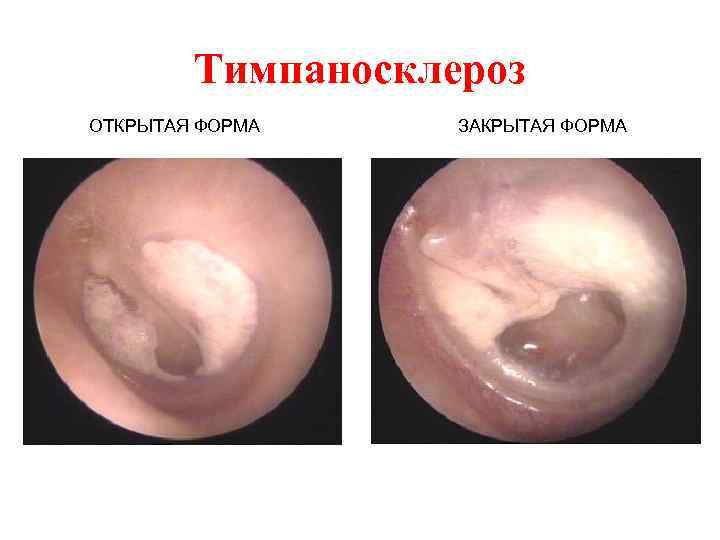 Тимпаносклероз ОТКРЫТАЯ ФОРМА ЗАКРЫТАЯ ФОРМА 