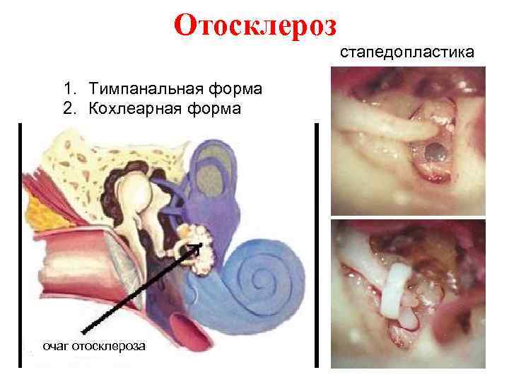 Отосклероз 1. Тимпанальная форма 2. Кохлеарная форма очаг отосклероза стапедопластика 