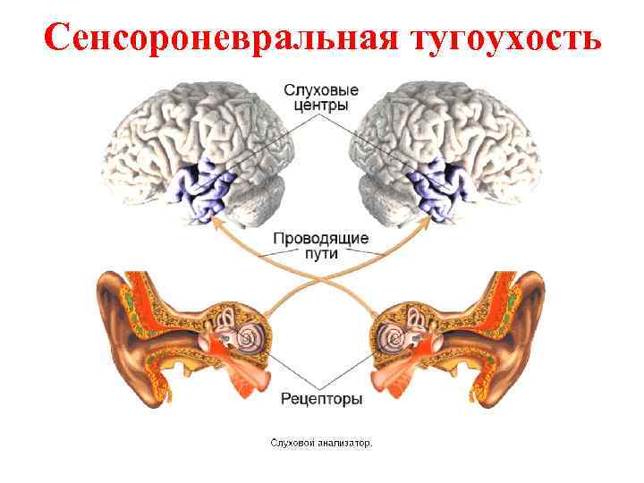 Сенсороневральная тугоухость 