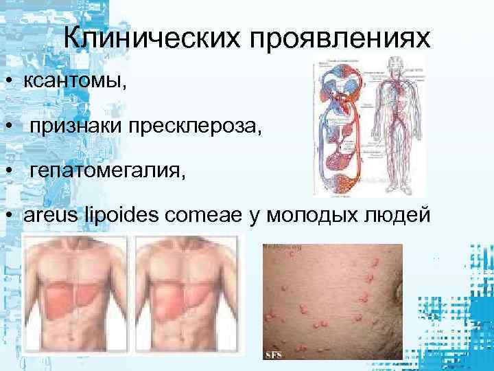 Клинических проявлениях • ксантомы, • признаки пресклероза, • гепатомегалия, • areus lipoides comeae у