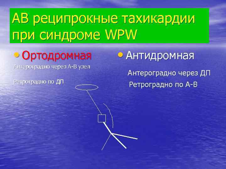 АВ реципрокные тахикардии при синдроме WPW • Ортодромная • Антидромная Антероградно через А-В узел