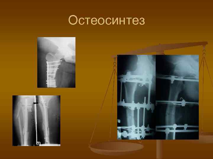 Внеочаговый остеосинтез презентация