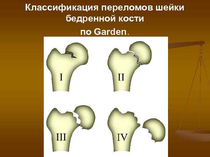 Классификация переломов шейки бедренной кости по Garden. 