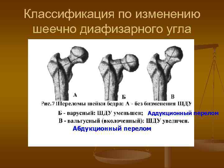 Классификация по изменению шеечно диафизарного угла - Аддукционный перелом Абдукционный перелом 