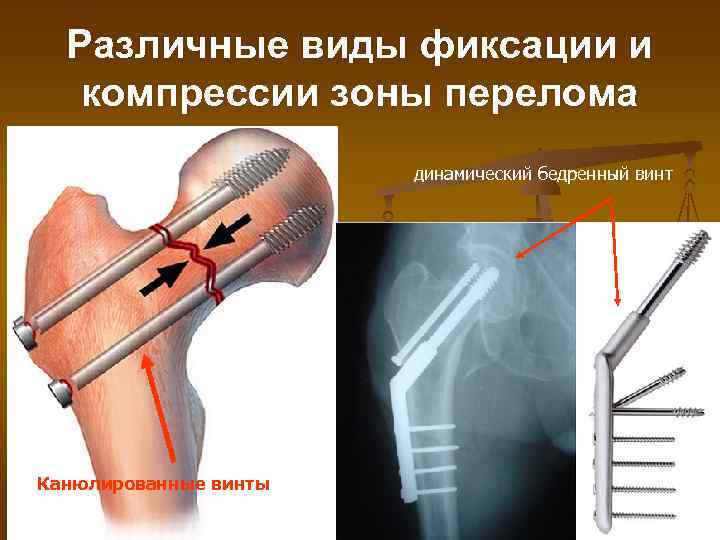 Различные виды фиксации и компрессии зоны перелома динамический бедренный винт Канюлированные винты 