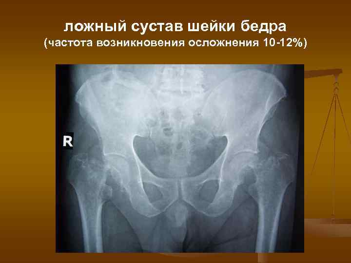 ложный сустав шейки бедра (частота возникновения осложнения 10 -12%) 