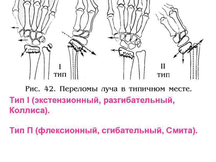 Тип I (экстензионный, разгибательный, Коллиса). Тип П (флексионный, сгибательный, Смита). 