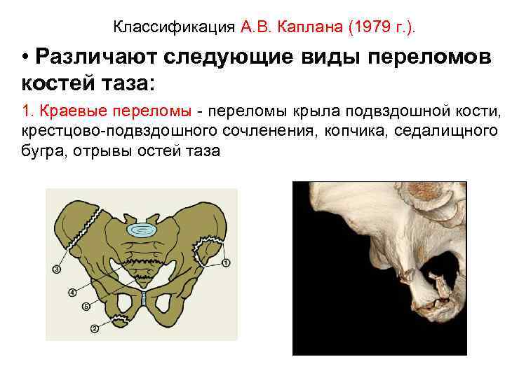 Классификация А. В. Каплана (1979 г. ). • Различают следующие виды переломов костей таза: