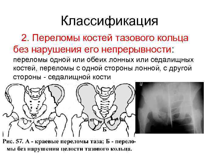 Переломы костей таза презентация