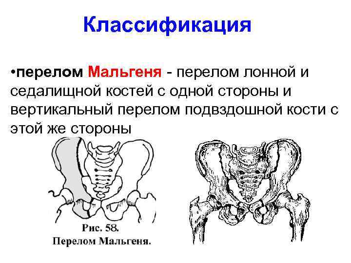 Переломы костей таза презентация травматология