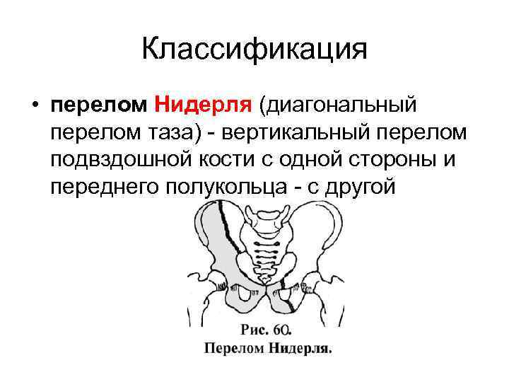 Классификация • перелом Нидерля (диагональный перелом таза) - вертикальный перелом подвздошной кости с одной