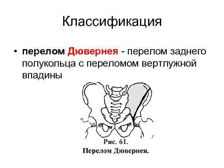 Классификация • перелом Дювернея - перелом заднего полукольца с переломом вертлужной впадины 