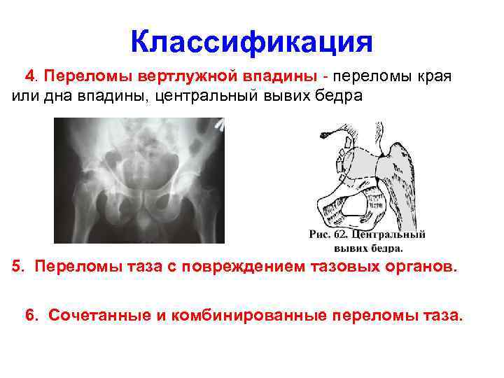 Переломы таза травматология презентация