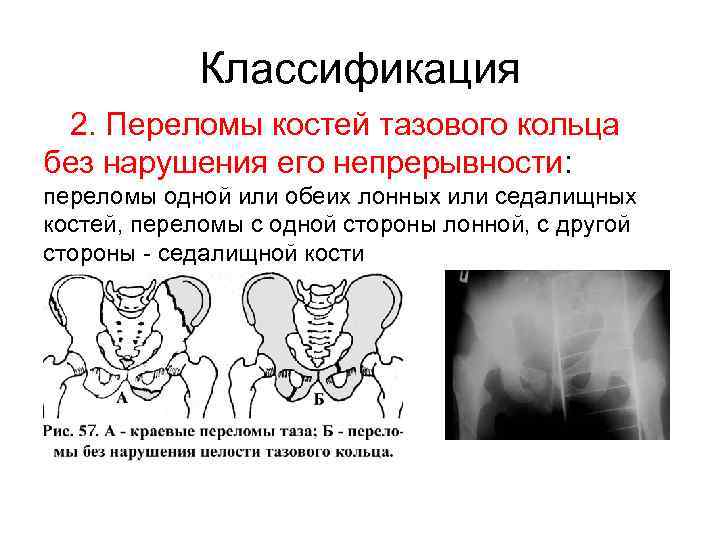 Классификация 2. Переломы костей тазового кольца без нарушения его непрерывности: переломы одной или обеих