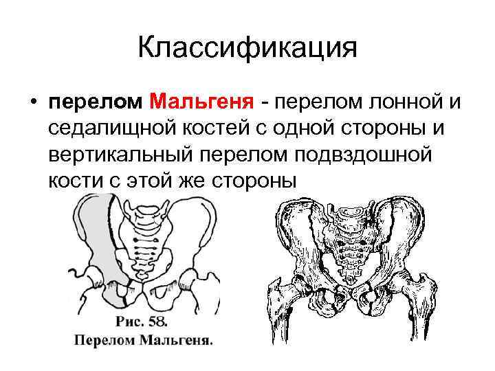 Компенсация дтп перелом лонной кости