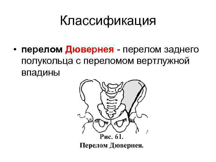 Классификация • перелом Дювернея перелом заднего полукольца с переломом вертлужной впадины 