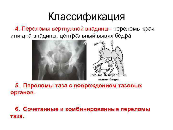 Перелом края вертлужной впадины