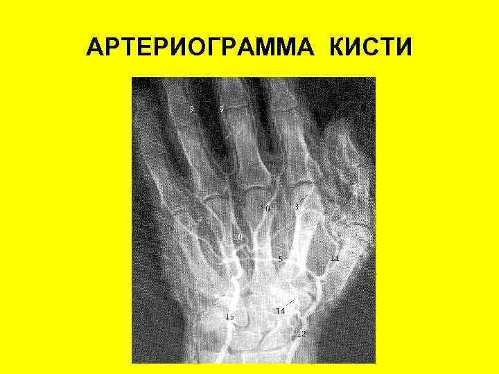 АРТЕРИОГРАММА КИСТИ 