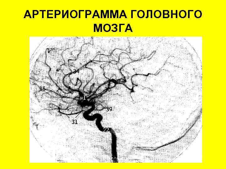 АРТЕРИОГРАММА ГОЛОВНОГО МОЗГА 