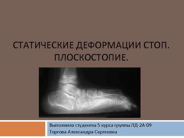 СТАТИЧЕСКИЕ ДЕФОРМАЦИИ СТОП. ПЛОСКОСТОПИЕ. Выполнила студентка 5 курса группы ЛД-2 А-09 Торгова Александра Сергеевна