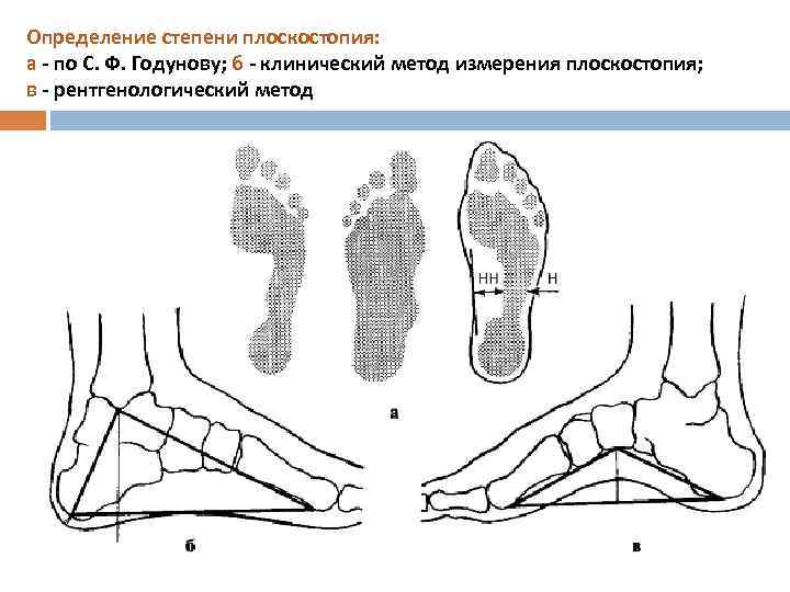 Определение степени плоскостопия: а - по С. Ф. Годунову; б - клинический метод измерения
