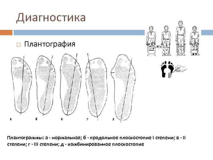 Диагностика Плантография Плантограммы: а - нормальная; б - продольное плоскостопие I степени; в -