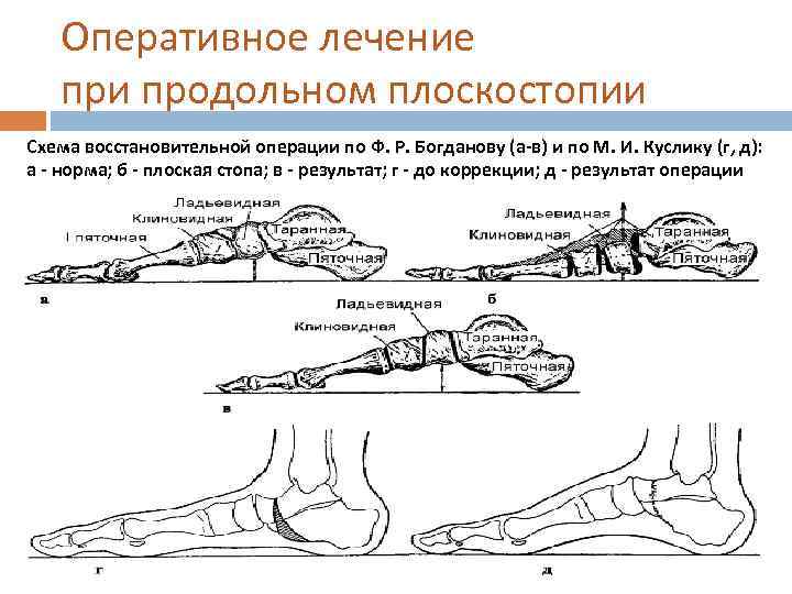 Оперативное лечение при продольном плоскостопии Схема восстановительной операции по Ф. Р. Богданову (а-в) и