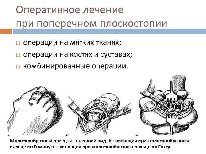Оперативное лечение при поперечном плоскостопии операции на мягких тканях; операции на костях и суставах;