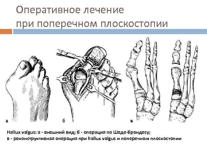 Оперативное лечение при поперечном плоскостопии Hallux valgus: a - внешний вид; б - операция