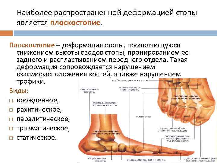 Наиболее распространенной деформацией стопы является плоскостопие. Плоскостопие – деформация стопы, проявляющуюся снижением высоты сводов