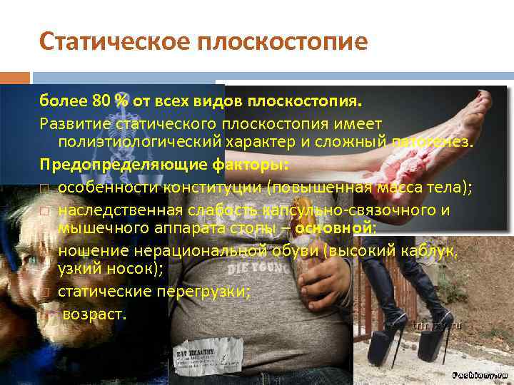 Статическое плоскостопие более 80 % от всех видов плоскостопия. Развитие статического плоскостопия имеет полиэтиологический