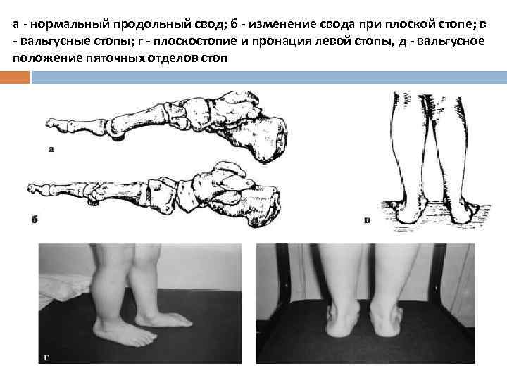 а - нормальный продольный свод; б - изменение свода при плоской стопе; в -