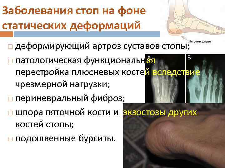 Заболевания стоп на фоне статических деформаций деформирующий артроз суставов стопы; патологическая функциональная перестройка плюсневых