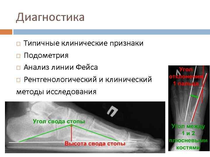 Диагностика Типичные клинические признаки Подометрия Анализ линии Фейса Рентгенологический и клинический методы исследования 