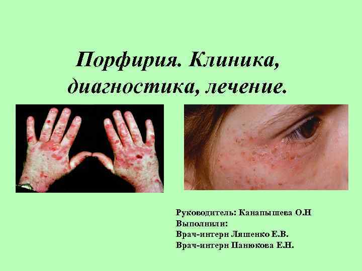 Порфирия. Клиника, диагностика, лечение. Руководитель: Канапышева О. Н Выполнили: Врач-интерн Ляшенко Е. В. Врач-интерн