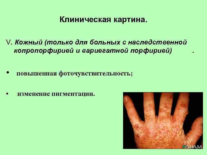 Клиническая картина. V. Кожный (только для больных с наследственной копропорфирией и вариегатной порфирией). •