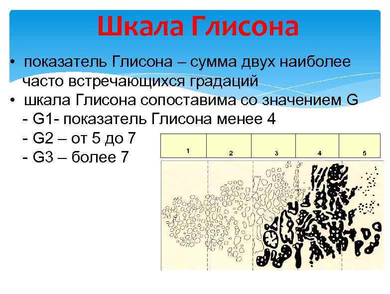 Шкала Глисона • показатель Глисона – сумма двух наиболее часто встречающихся градаций • шкала