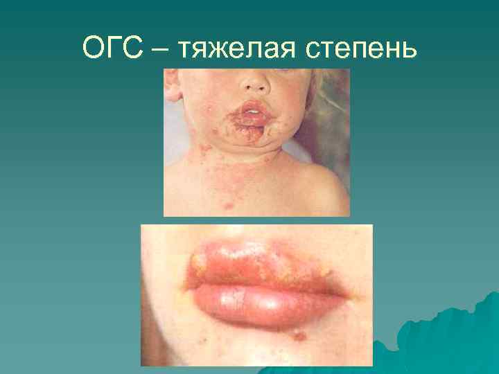 ОГС – тяжелая степень 