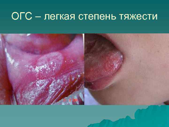 ОГС – легкая степень тяжести 