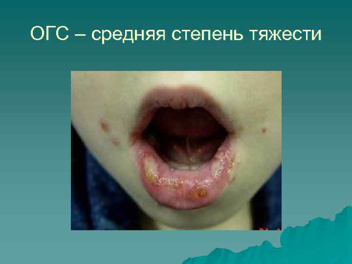 ОГС – средняя степень тяжести 