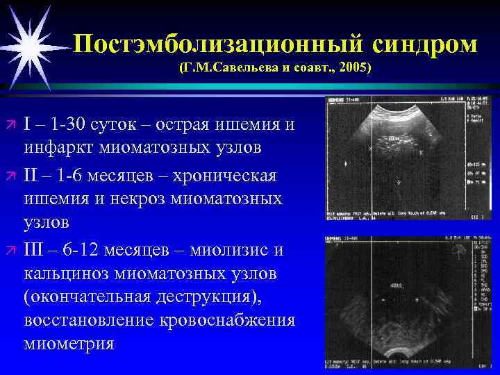 Постэмболизационный синдром (Г. М. Савельева и соавт. , 2005) ä ä ä І –