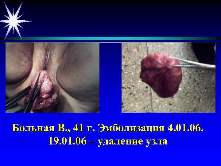 Больная В. , 41 г. Эмболизация 4. 01. 06. 19. 01. 06 – удаление