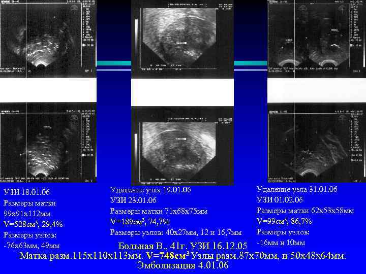 УЗИ 18. 01. 06 Размеры матки 99 х91 х112 мм V=528 cм 3, 29,