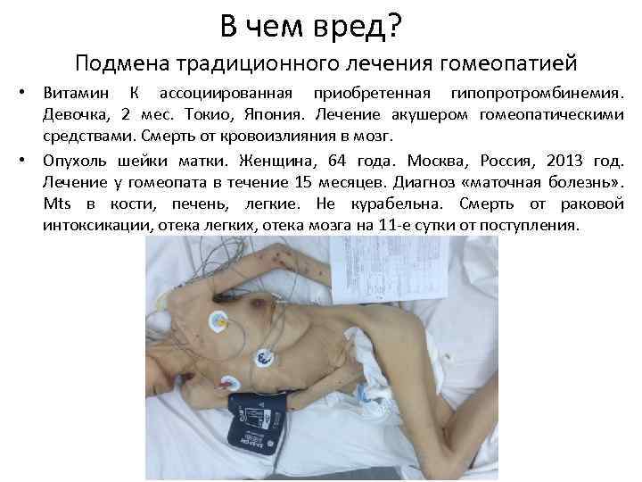 В чем вред? Подмена традиционного лечения гомеопатией • Витамин К ассоциированная приобретенная гипопротромбинемия. Девочка,