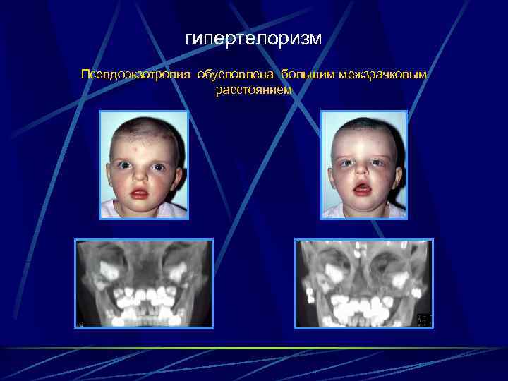 гипертелоризм Псевдоэкзотропия обусловлена большим межзрачковым расстоянием 