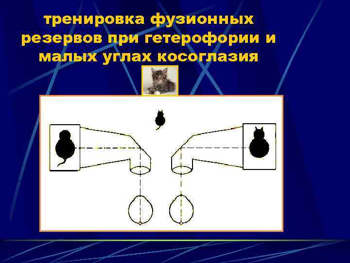 тренировка фузионных резервов при гетерофории и малых углах косоглазия 